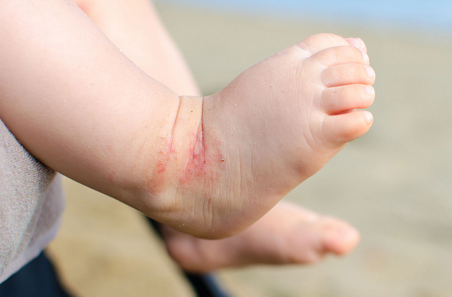 /upload/resize_cache/iblock/22a/660_440_1/childs_farm_eczema.jpg